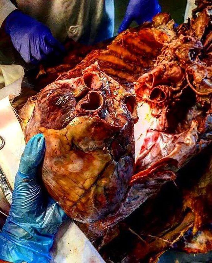 Cardiomegaly!!! 