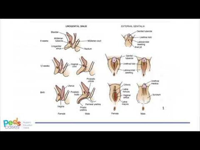 Disorders of Sexual Development