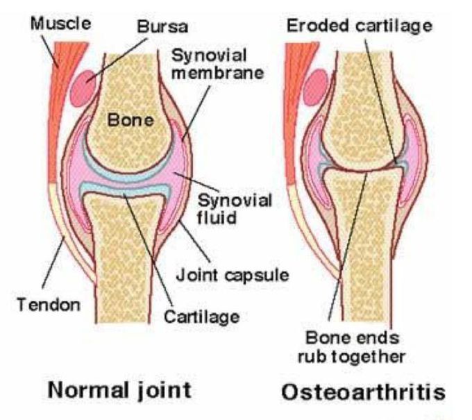 Osteo arthritis