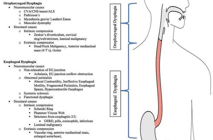 Causes of dysphagia