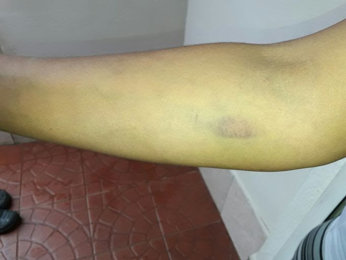 After a blood draw a bruise was done and the arm was swollen MEDizzy