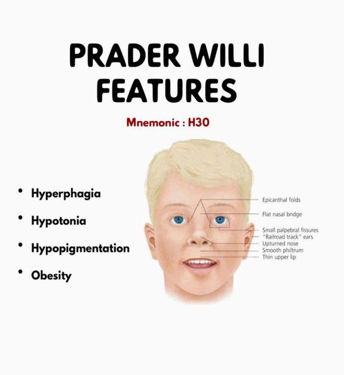 Prader–Willi syndrome- Features