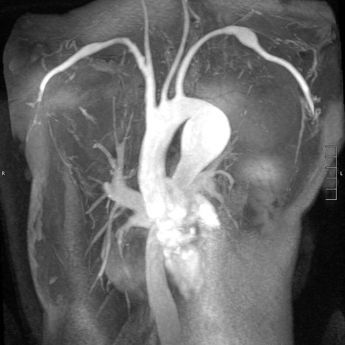 MRI of a Descending thoracic aortic aneurysm in a patient with Marfan syndrome