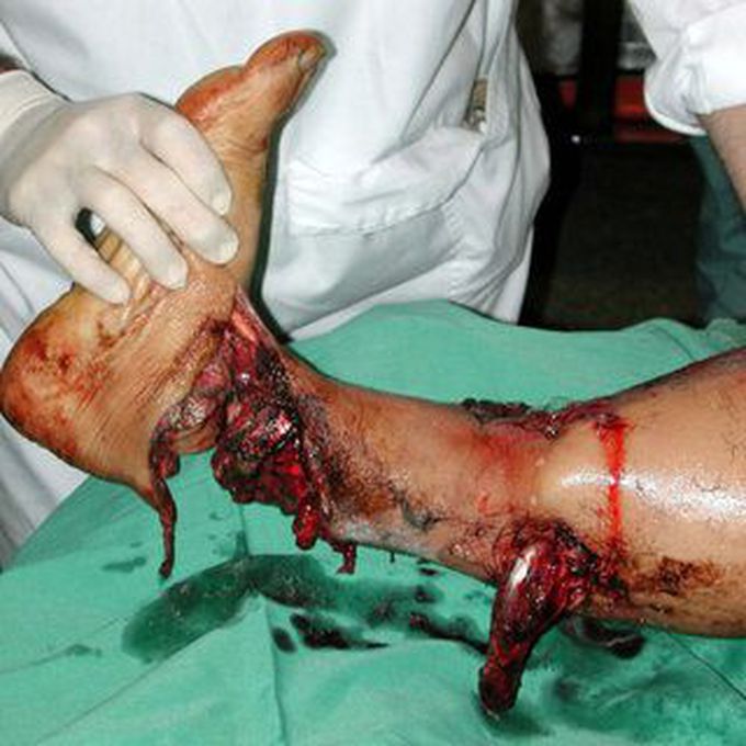 Eighteen-year-old male patient with severe Gustilo type IIIC injury of the ankle after a motorcycle accident.