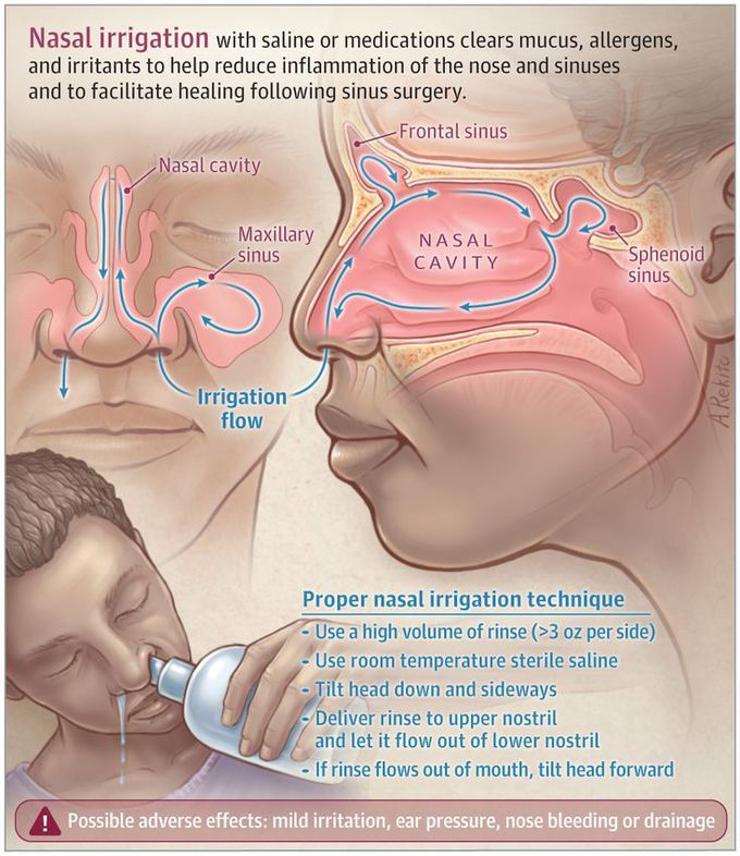This Patient Page describes the use of a saline nasal rinse to reduce the frequency and severity of the sym… | Medical knowledge, Medical anatomy, Medical education