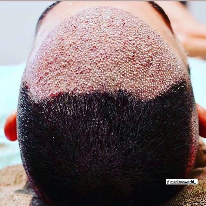 Hair Transplant Surgery