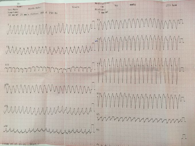 ECG (electrocardiogram)