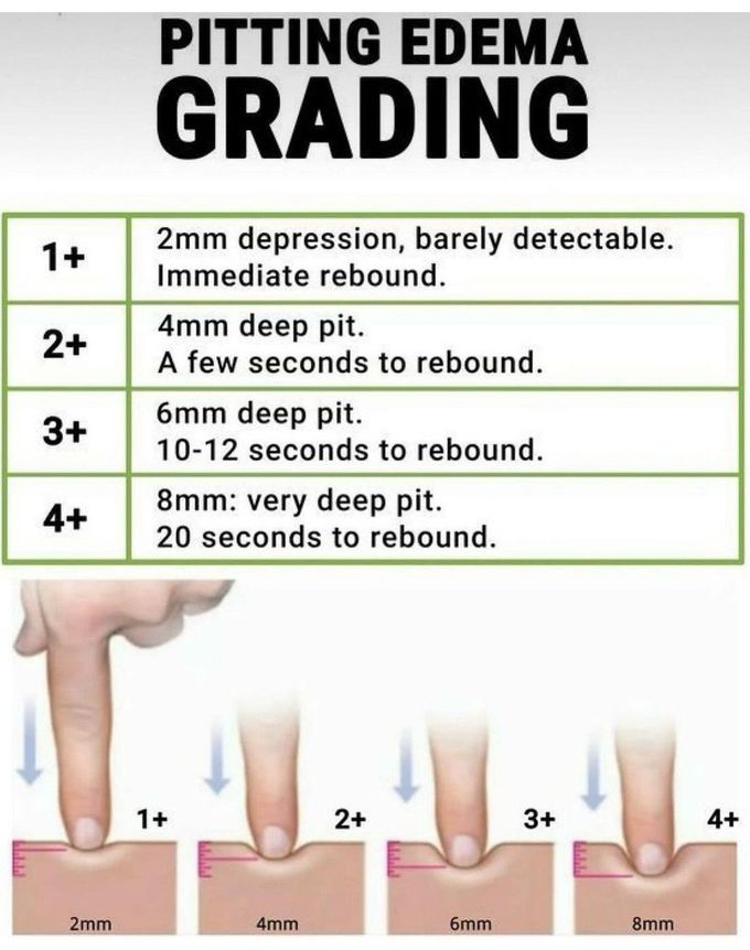 Pitting Edema