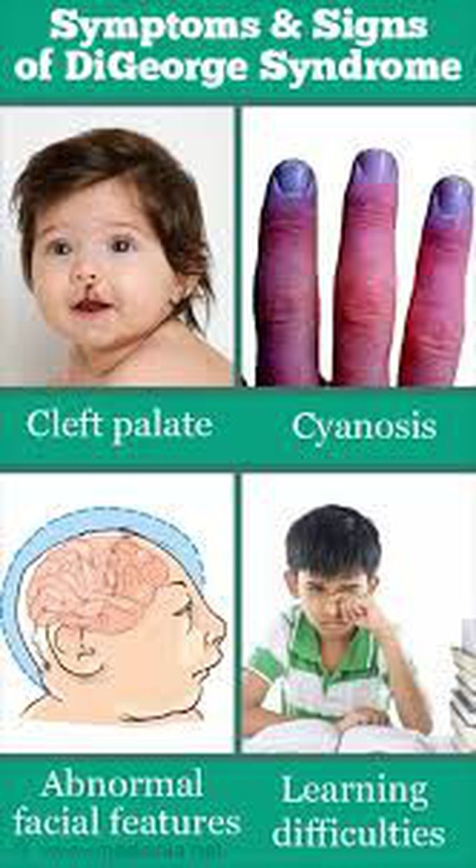 Digeorge syndrome symptoms