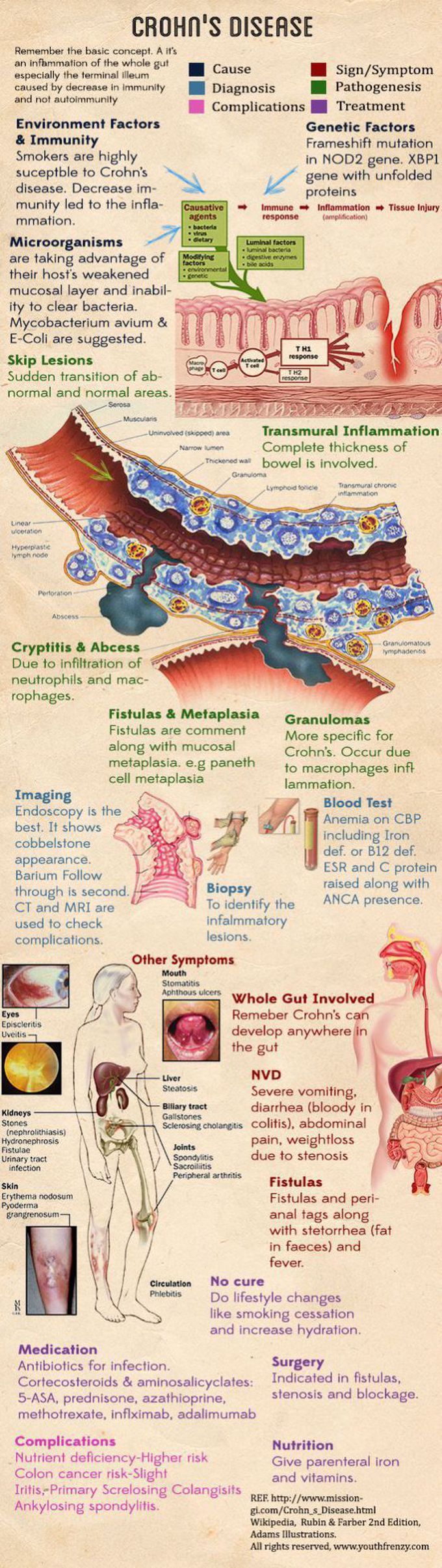 Crohn’s Disease | Crohns disease, Medical education, Medical