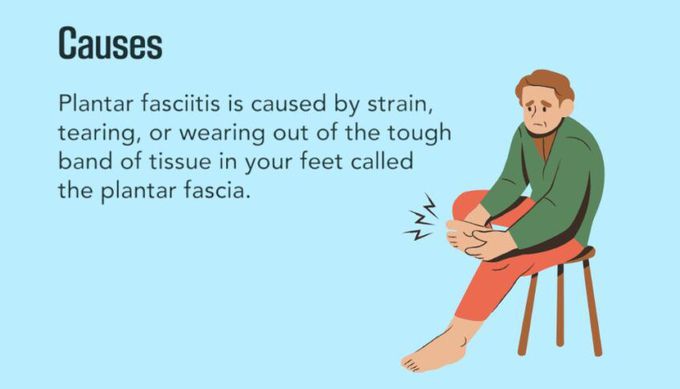 Cause of Plantar fasciitis