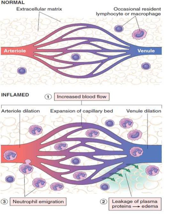 Acute Inflammation