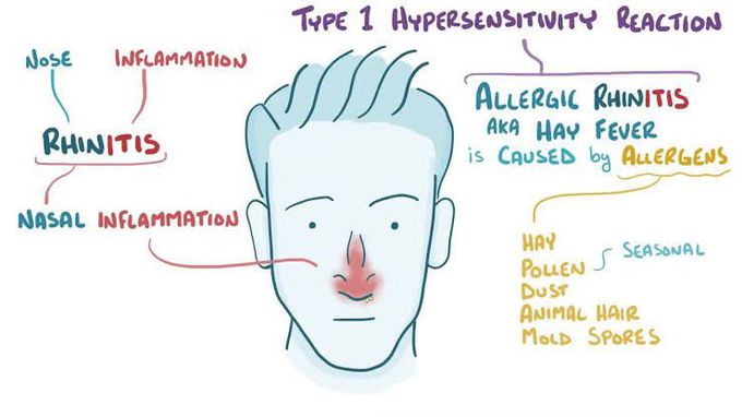 Allergic Rhinitis Signs And Symptoms