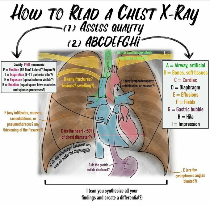 How to read a CXR