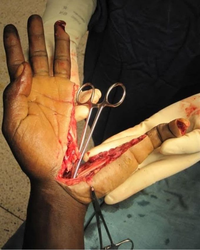 ⚠️ This is a case of severe hand trauma caused by a machete! 