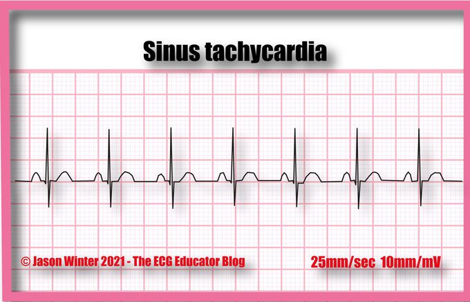 Sinus Tachycardia