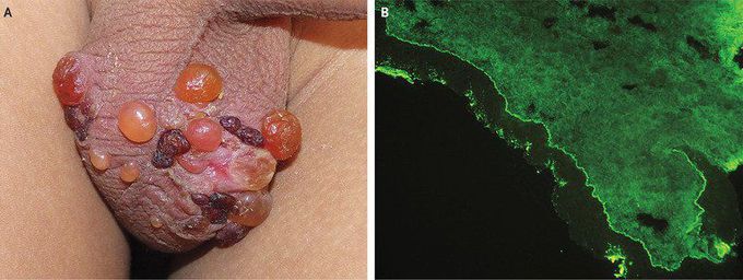 Asymptomatic Blisters On 5-Year-Old's Scrotum