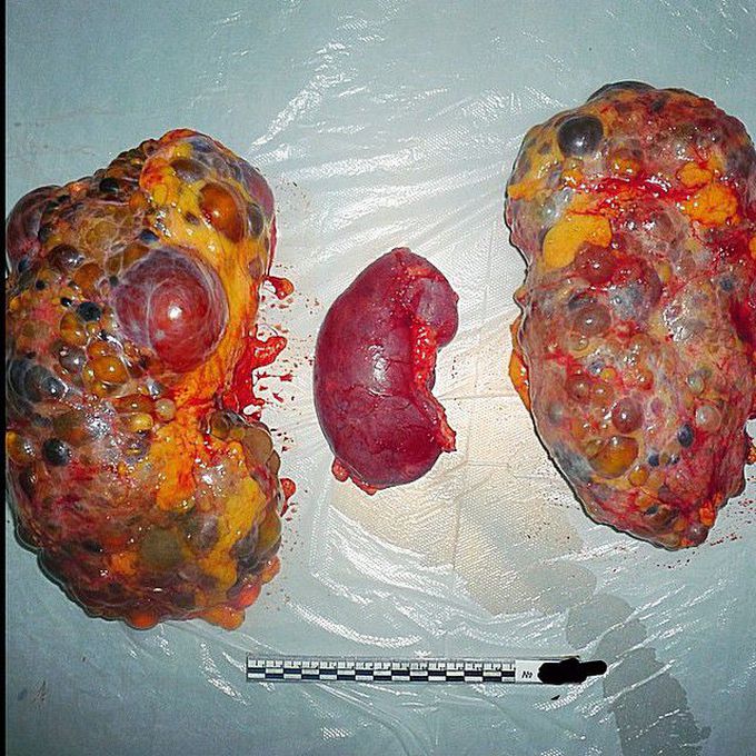 Polycystic kidneys vs. normal kidney (in the center)