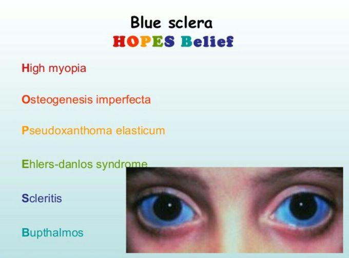 Blue sclera