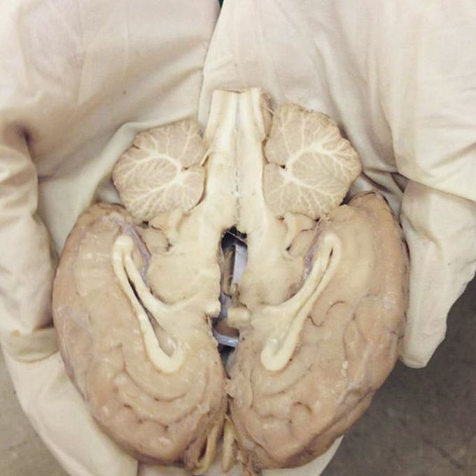 An amazing dissection of the brain