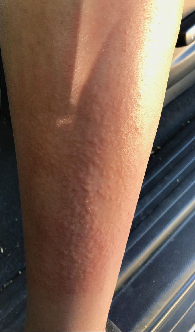Rash?