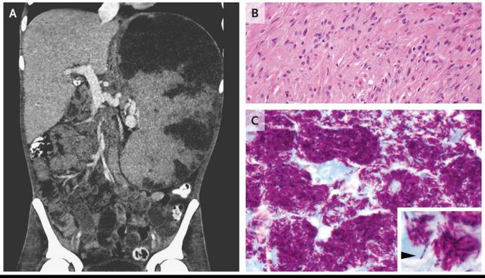 Massive Splenomegaly from Disseminated Mycobacterium avium–intracellulare Infection