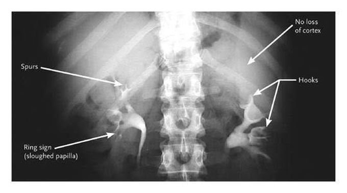 Renal papillary necrosis