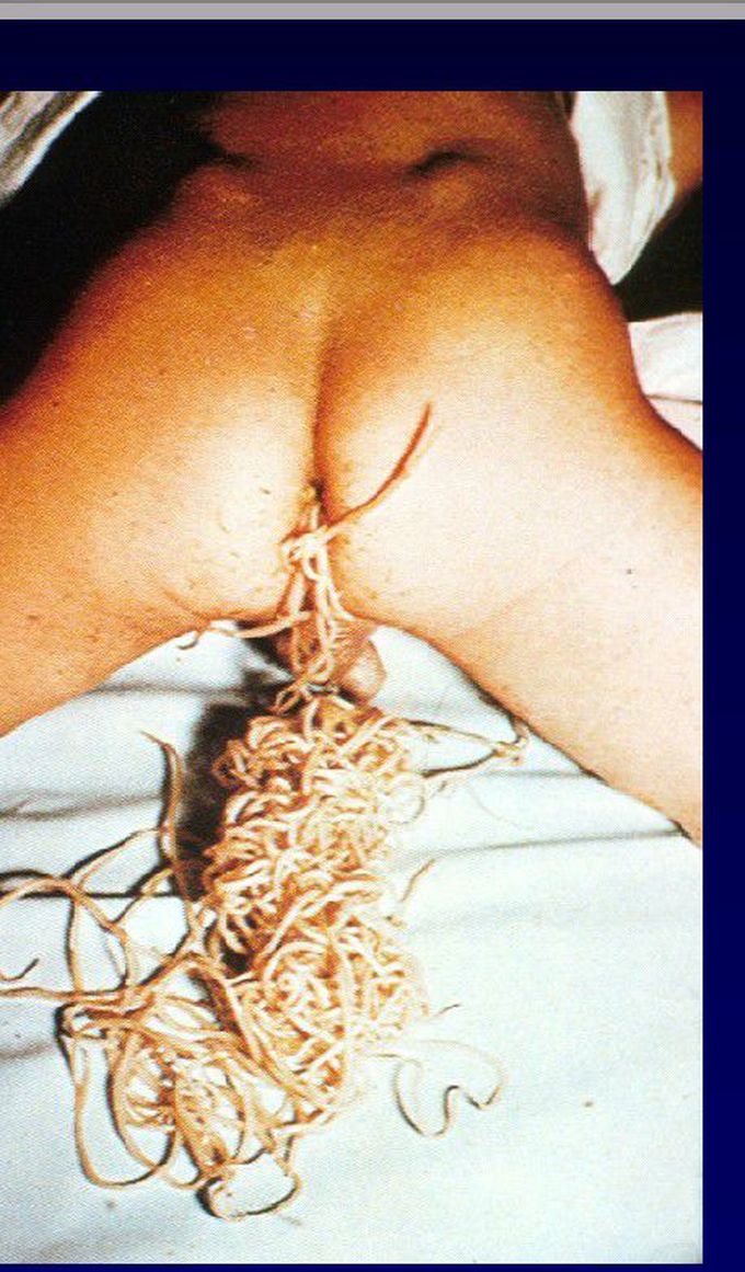 AMAZING INTESTINAL PARASITE
