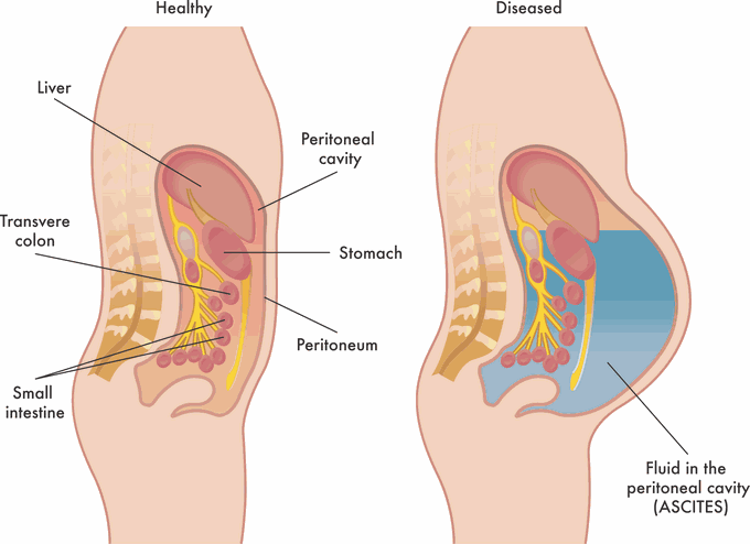 What causes ascites?