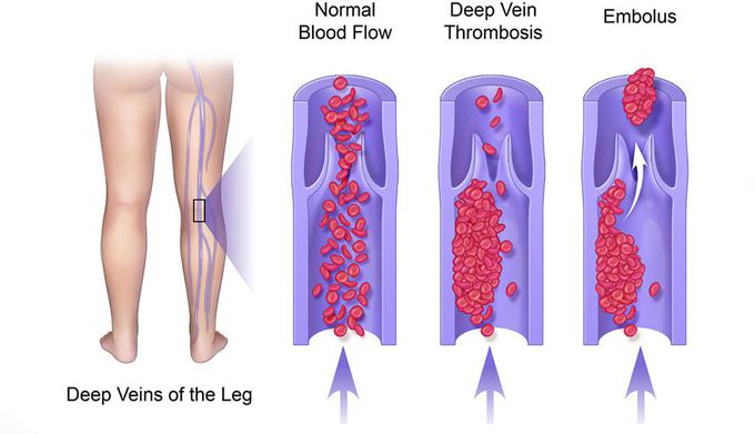 Deep vein thrombosis