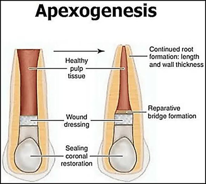 Apexogenesis