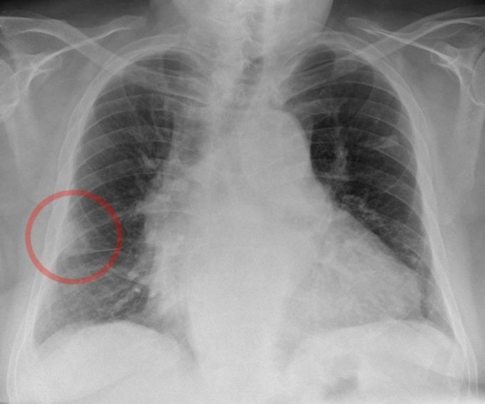 Pulmonary embolism
