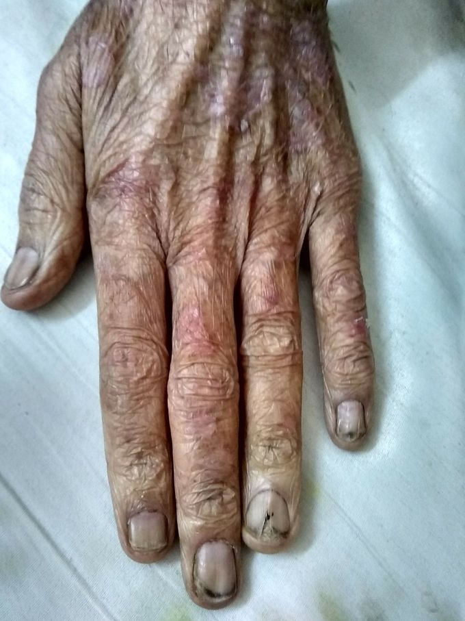 Nail Psoriasis