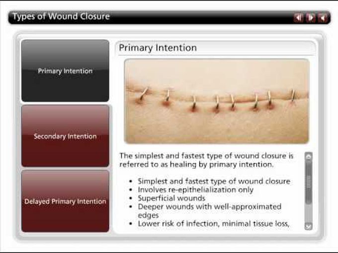 Wound Healing- Types