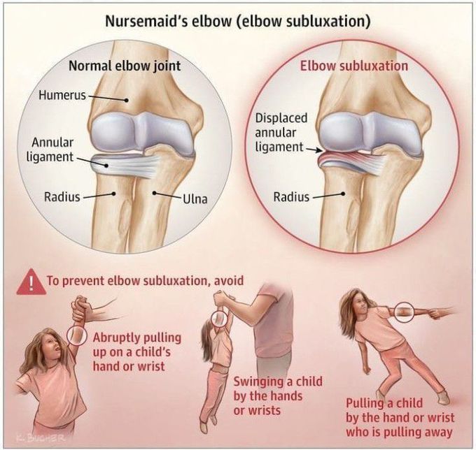 Nursemaid's elbow