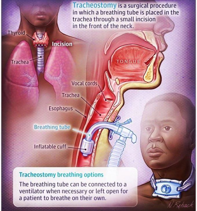 Tracheostomy