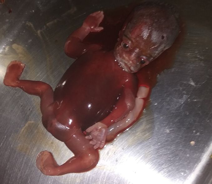 IUFD of 22 weels Pregnancy