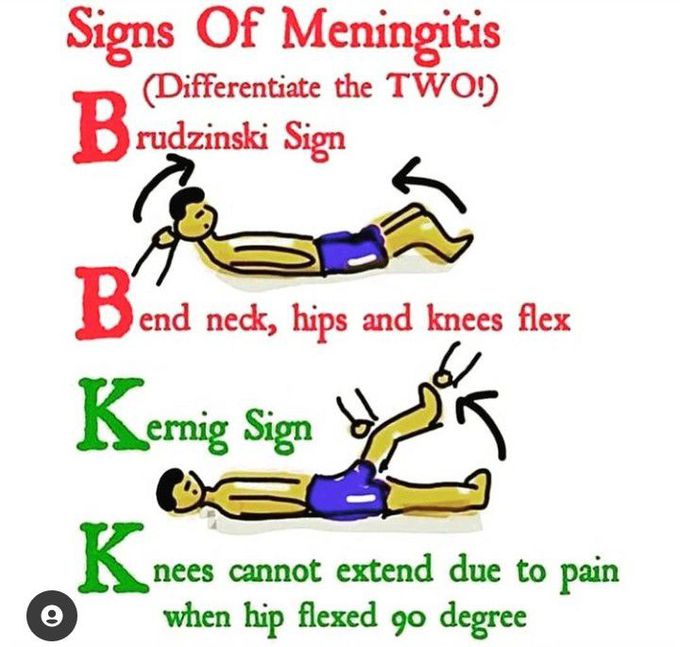 Signs of meningitis