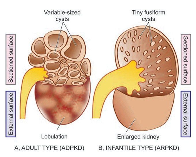 Polycystic kidney disease