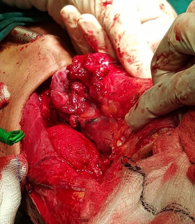 Total laryngectomy