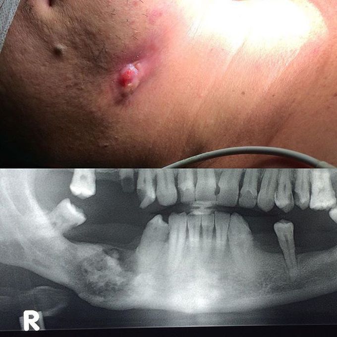 Chronic osteomyelitis on mandible