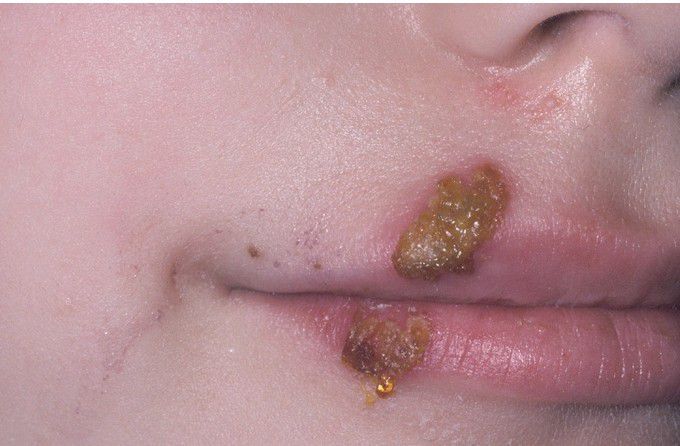 Impetigo