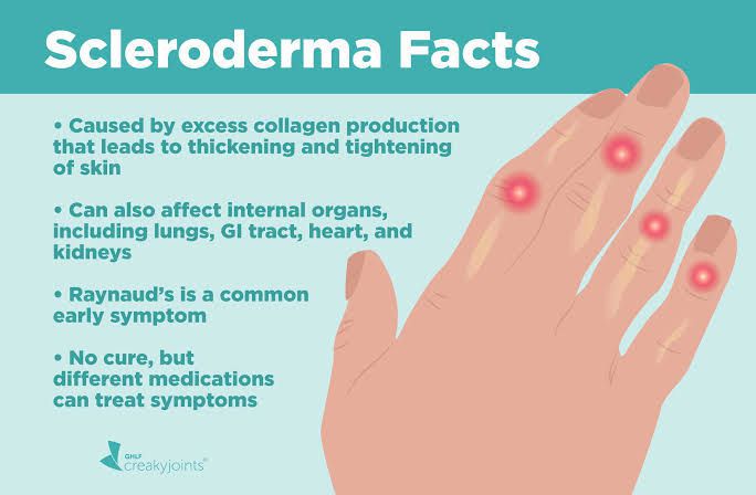 Complications Of Scleroderma Medizzy 7915