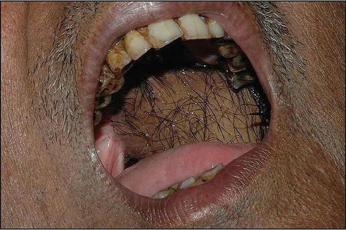 Hairy intraoral flaps