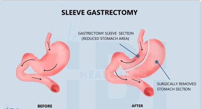 Procedure of sleeve gastrectomy