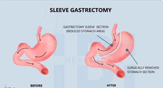Procedure of sleeve gastrectomy