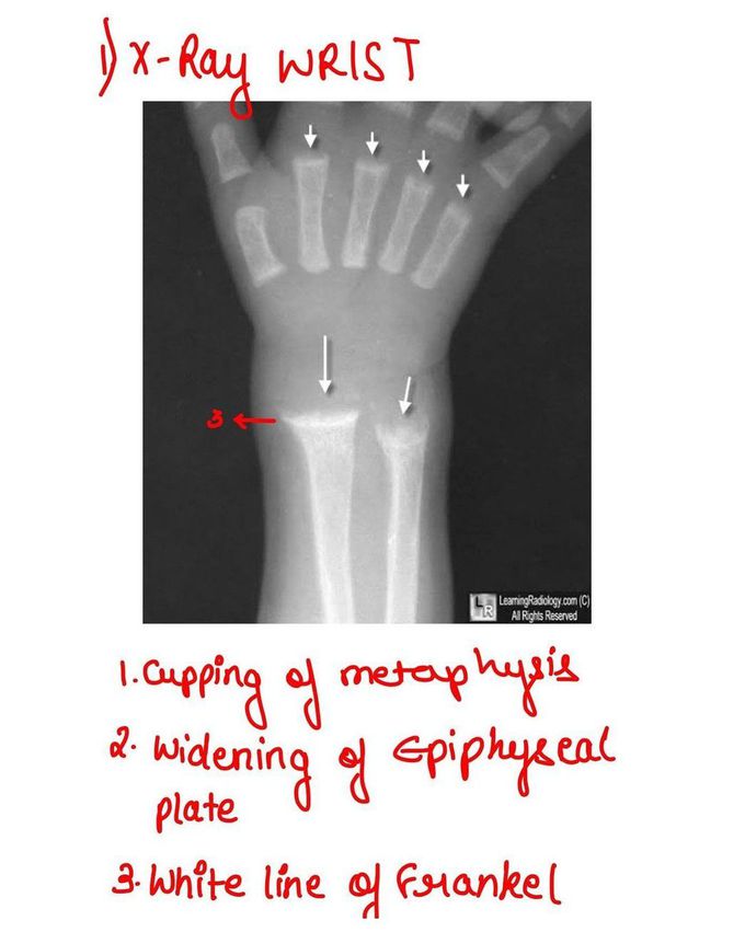 Rickets - X-ray Wrist
