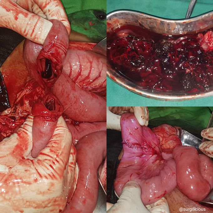Trauma laparotomy 
