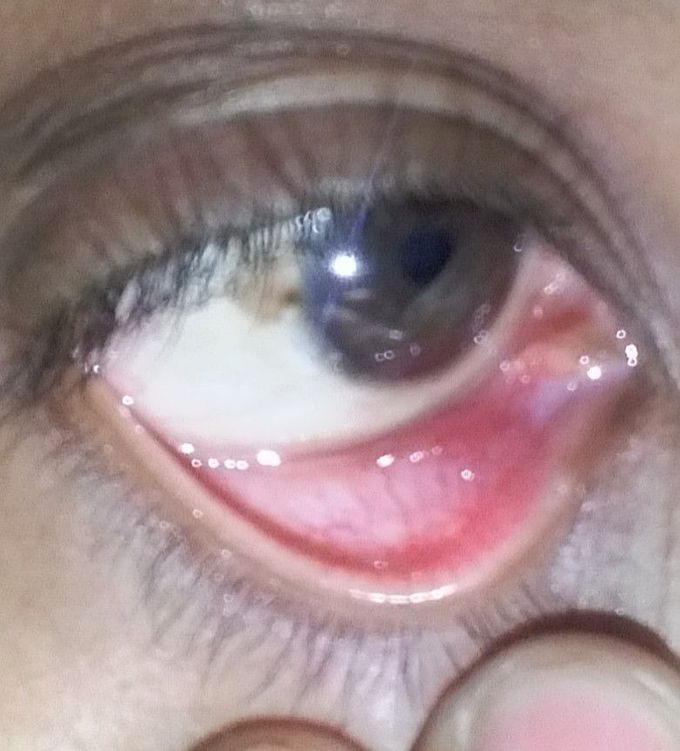 A 21 year old girl come with a symptoms of redness in medial part of lower conjunctiva and it pains on closing the eyelids and tired from morning with whole body pain. What is your Diagnosis Dx??
