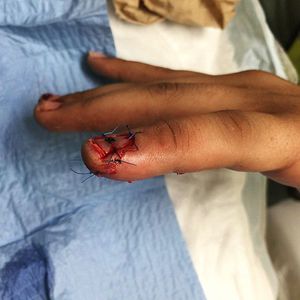 Fingertip reconstruction - MEDizzy